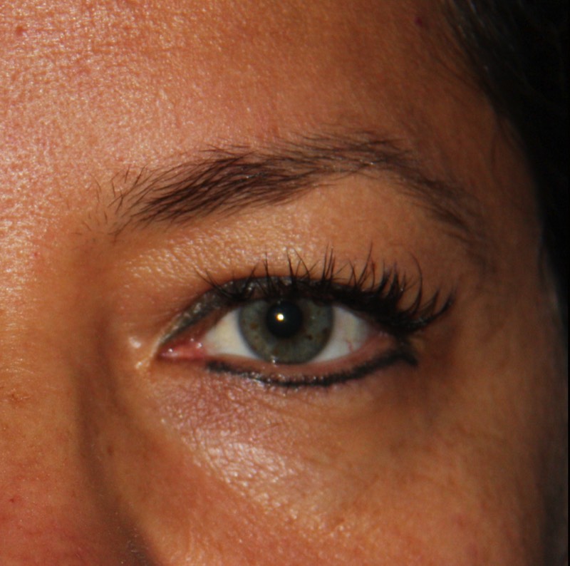foto close up ojo antes cirugia