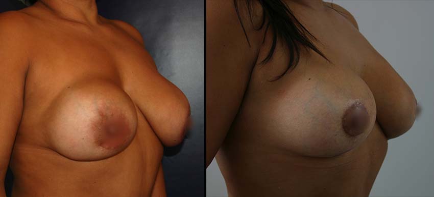 fotos senos oblicuas con capsula